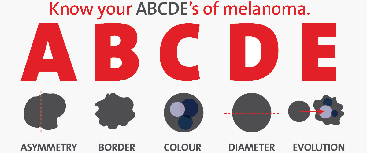 doctors-of-tewantin-skin-cancer-information-and-check-tewantin